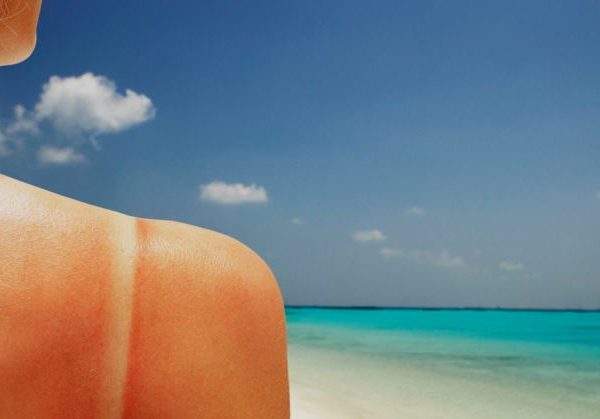 negative effects of sunburn